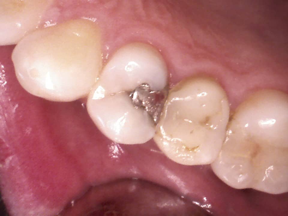 insuffiziente Amalgamfüllung
