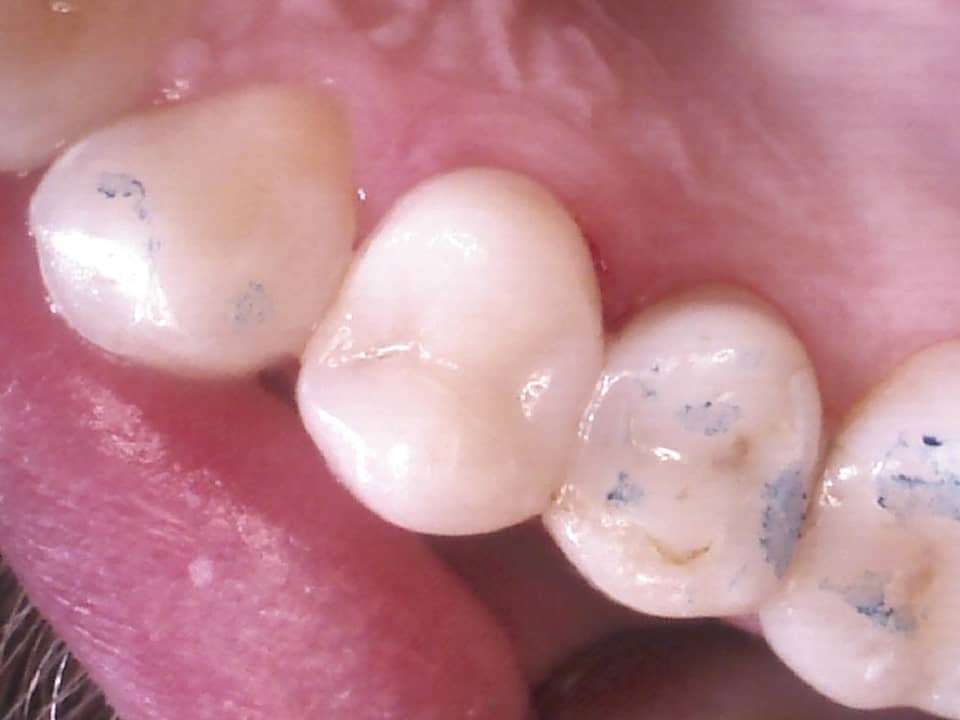 fertige Kompositfüllung