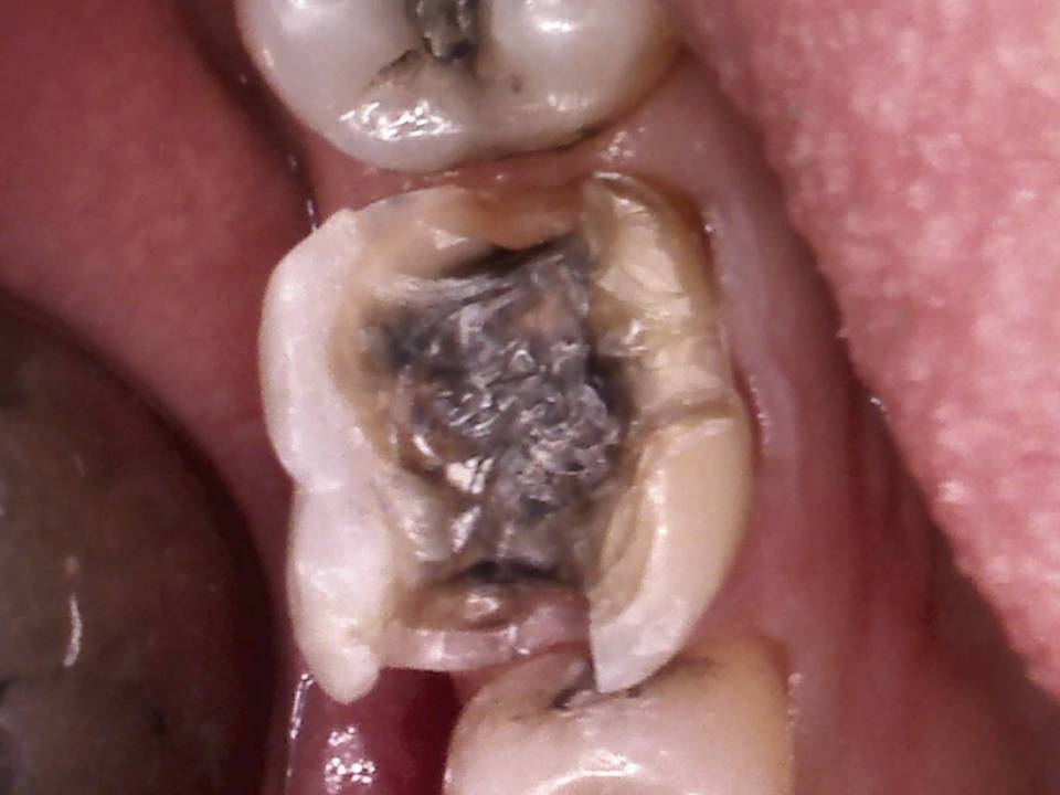 Entfernung der alten Füllung